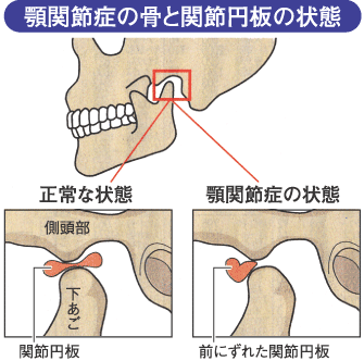 関節 ない 治ら 顎 症